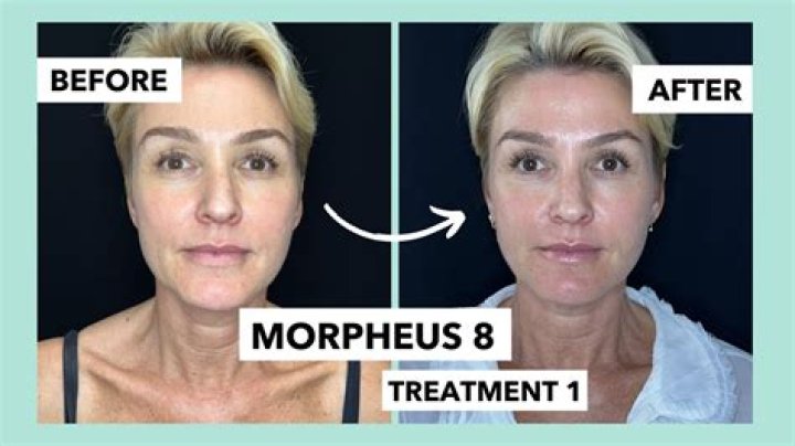 Morpheus8 Ruined My Skin: A Candid Review of My Experience